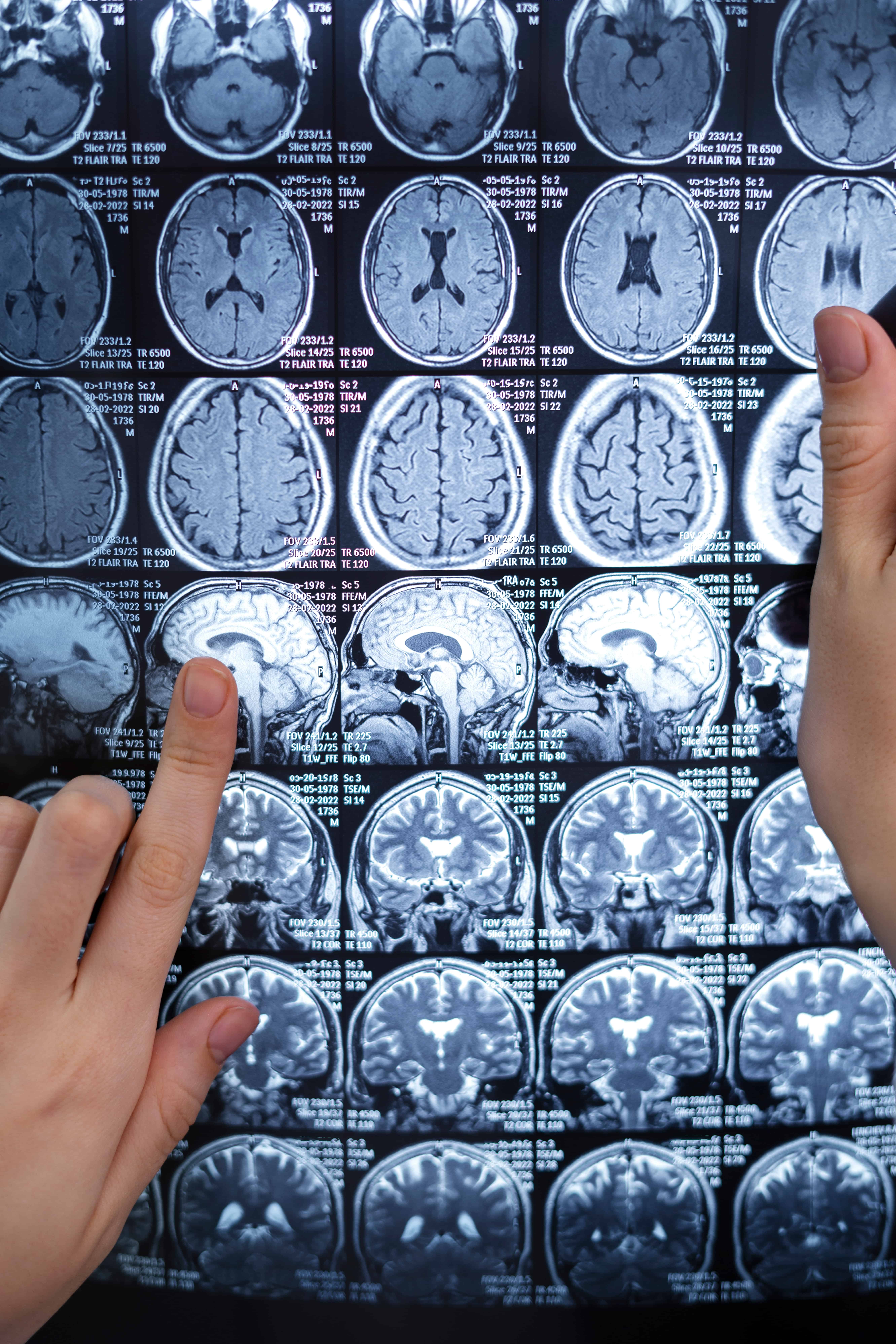 Neurological Study